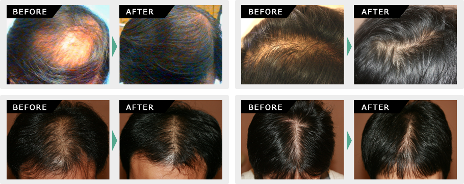 HARGカクテル療法による症例イメージ